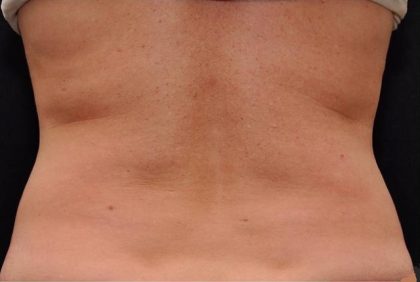 Coolsculpting Before & After Patient #2734