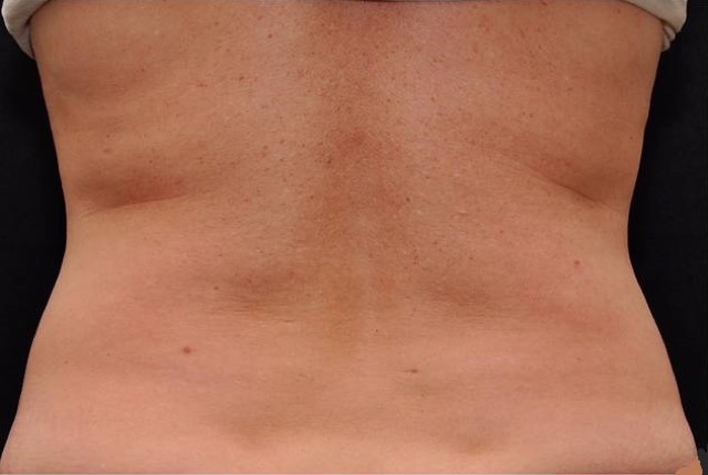 Coolsculpting Before & After Patient #2734