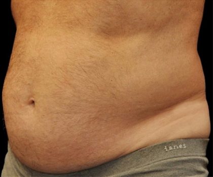 Coolsculpting Before & After Patient #2734