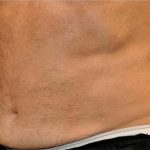 Coolsculpting Before & After Patient #2734