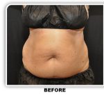 Coolsculpting Before & After Patient #2697