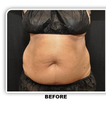 Coolsculpting Before & After Patient #2697