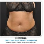 Coolsculpting Before & After Patient #2697