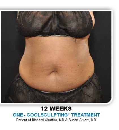 Coolsculpting Before & After Patient #2697