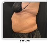 Coolsculpting Before & After Patient #2697