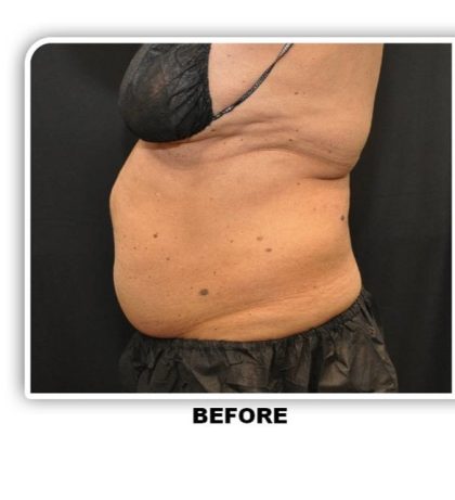 Coolsculpting Before & After Patient #2697