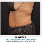 Coolsculpting Before & After Patient #2697