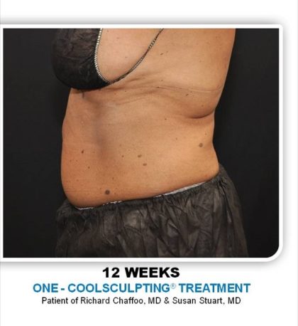 Coolsculpting Before & After Patient #2697