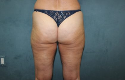 Coolsculpting Before & After Patient #2694