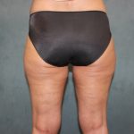 Coolsculpting Before & After Patient #2694