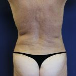 Brazilian Butt Lift Before & After Patient #1941