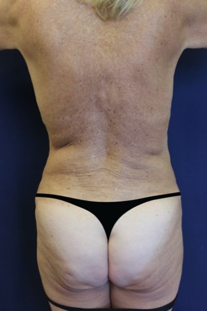 Brazilian Butt Lift Before & After Patient #1941
