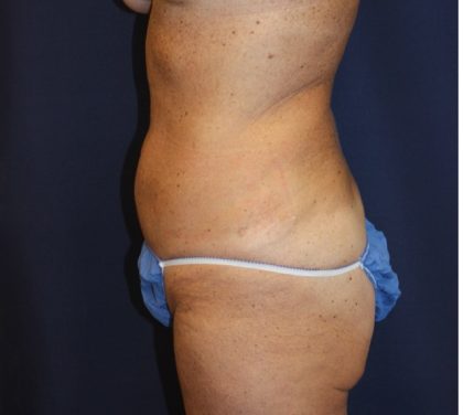 Brazilian Butt Lift Before & After Patient #1941