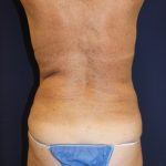 Brazilian Butt Lift Before & After Patient #1941