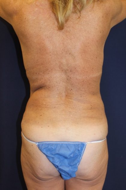 Brazilian Butt Lift Before & After Patient #1941