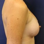 Breast Augmentation Before & After Patient #2417