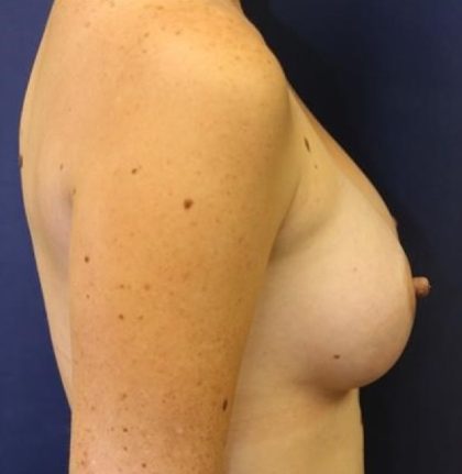 Breast Augmentation Before & After Patient #2417