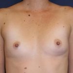 Breast Augmentation Before & After Patient #2417