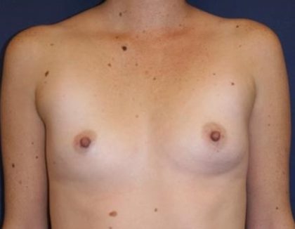 Breast Augmentation Before & After Patient #2417