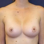 Breast Augmentation Before & After Patient #2417