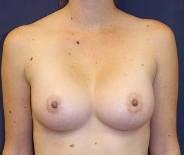 Breast Augmentation Before & After Patient #2417