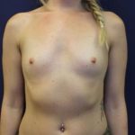 Breast Augmentation Before & After Patient #2352
