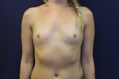 Breast Augmentation Before & After Patient #2352