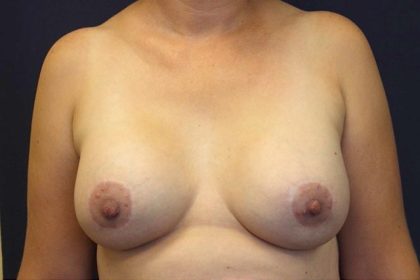 Breast Augmentation Before & After Patient #2546