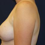 Breast Augmentation Before & After Patient #2546