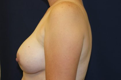Breast Augmentation Before & After Patient #2546