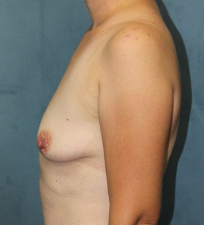 Breast Augmentation Before & After Patient #2546