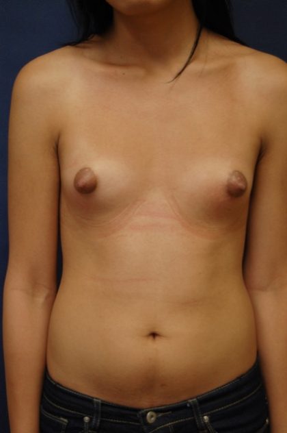 Breast Augmentation Before & After Patient #2151