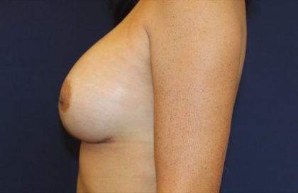 Breast Augmentation Before & After Patient #2528