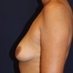 Breast Augmentation Before & After Patient #2528