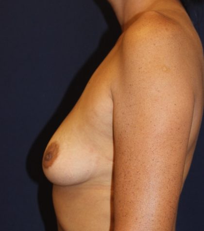 Breast Augmentation Before & After Patient #2528