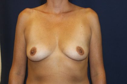 Breast Augmentation Before & After Patient #2528