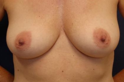 Breast Augmentation Before & After Patient #2322
