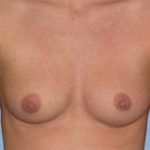 Breast Augmentation Before & After Patient #2288