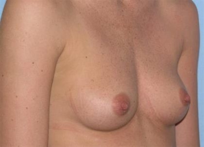 Breast Augmentation Before & After Patient #2288