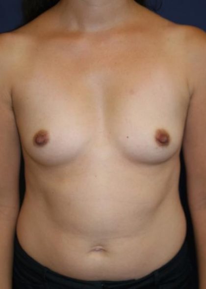 Breast Augmentation Before & After Patient #2230