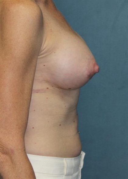 Breast Augmentation Before & After Patient #2241