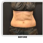 Coolsculpting Before & After Patient #2753