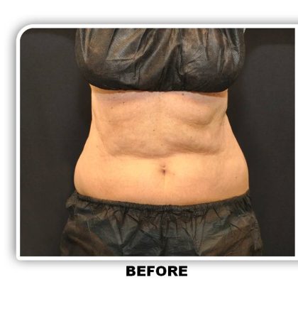 Coolsculpting Before & After Patient #2753