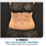 Coolsculpting Before & After Patient #2753