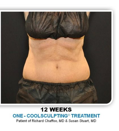 Coolsculpting Before & After Patient #2753