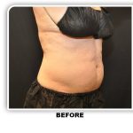 Coolsculpting Before & After Patient #2753