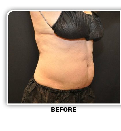 Coolsculpting Before & After Patient #2753