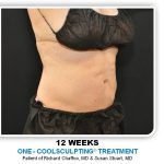 Coolsculpting Before & After Patient #2753