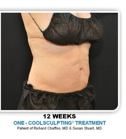 Coolsculpting Before & After Patient #2753