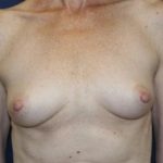 Breast Augmentation Before & After Patient #2241